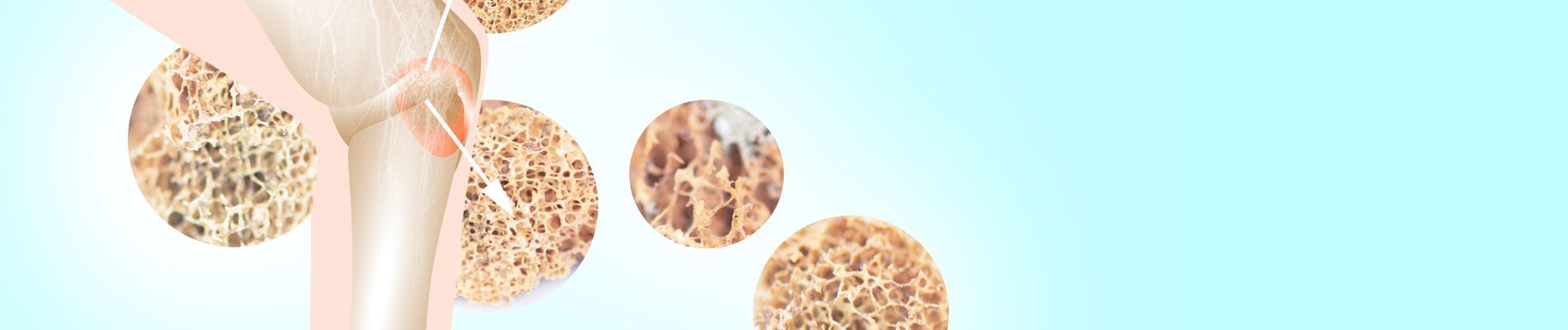 Knochendichtemessung - Diagnose Osteoporose absichern